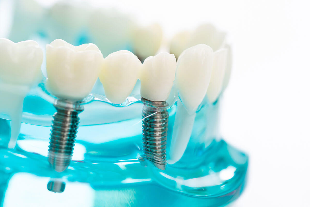 What Are The Different Types Of Dental Implants - vrogue.co